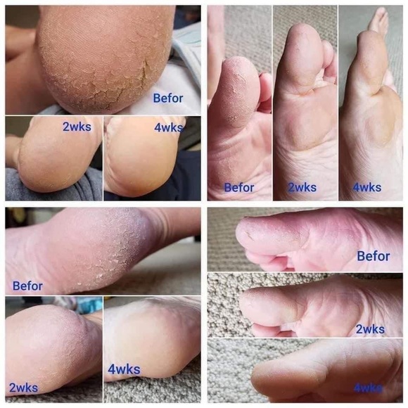 Sole solutions - foot treatment - Picture 1 of 2